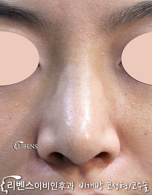휜 코 매부리코 메부리코 넓은 코뼈 절골 복코 코끝 수술 성형 s122